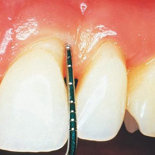 Probing Pocket Depth