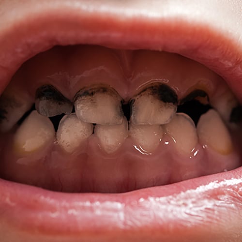 profed-rampant-caries