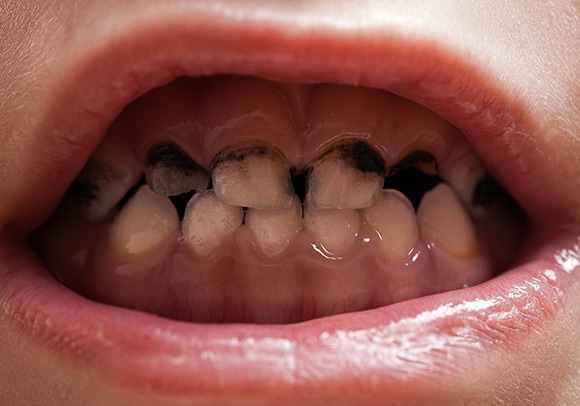 profed-rampant-caries