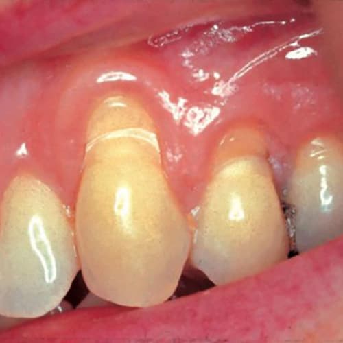 Localized Recession And Abrasion