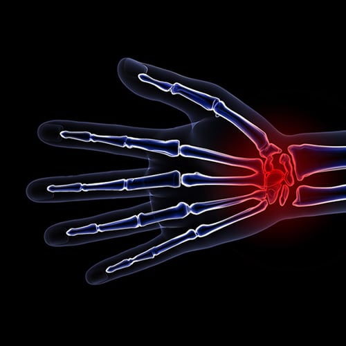 X-ray of hand with pain identified in red on the wrist